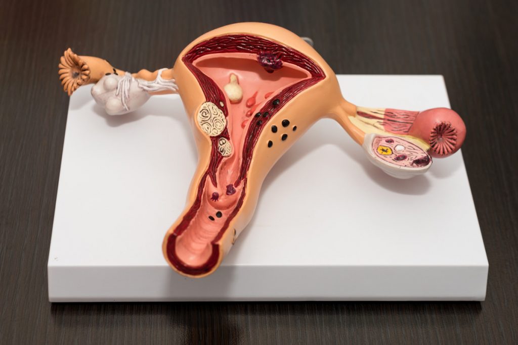 Endometriosis: Qué es y cuáles son los primeros síntomas para identificar
