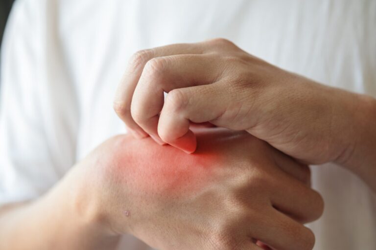 8 maneras fáciles de aliviar y calmar el enrojecimiento o la irritación rápidamente para las personas con piel sensible