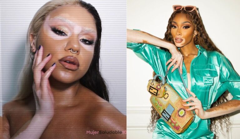5 modelos con vitíligo que rompen estándares de belleza